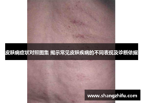 皮肤病症状对照图集 揭示常见皮肤疾病的不同表现及诊断依据